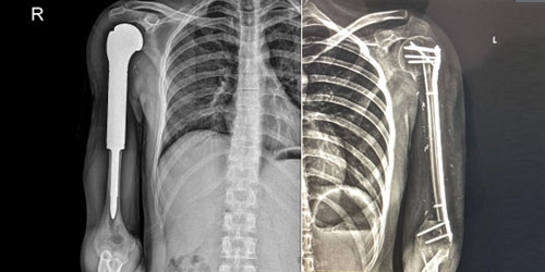 RECONSTRUCTION OF THE CAVITY AFTER TUMOR REMOVAL IN BONE TUMOR SURGERY