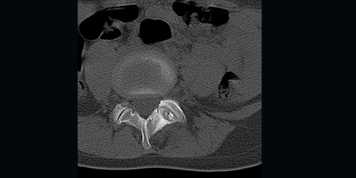 OSTEOBLASTOMA