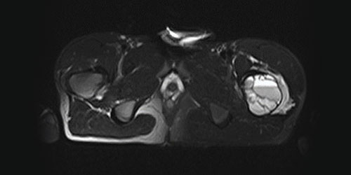 ANEURYSMAL BONE CYST