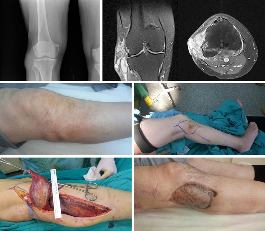 CLEAR CELL SARCOMA