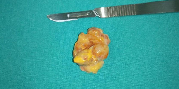 GIANT CELL TENDON TUMOR - PIGMENTED VILLONODULAR SYNOVITIS