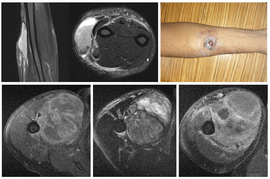 EPITHELIOID SARCOMA