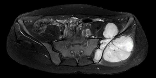 EWING SARCOMA