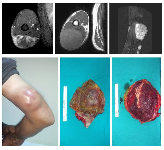 FIBROSARCOMA - MYXOFIBROSARCOMA