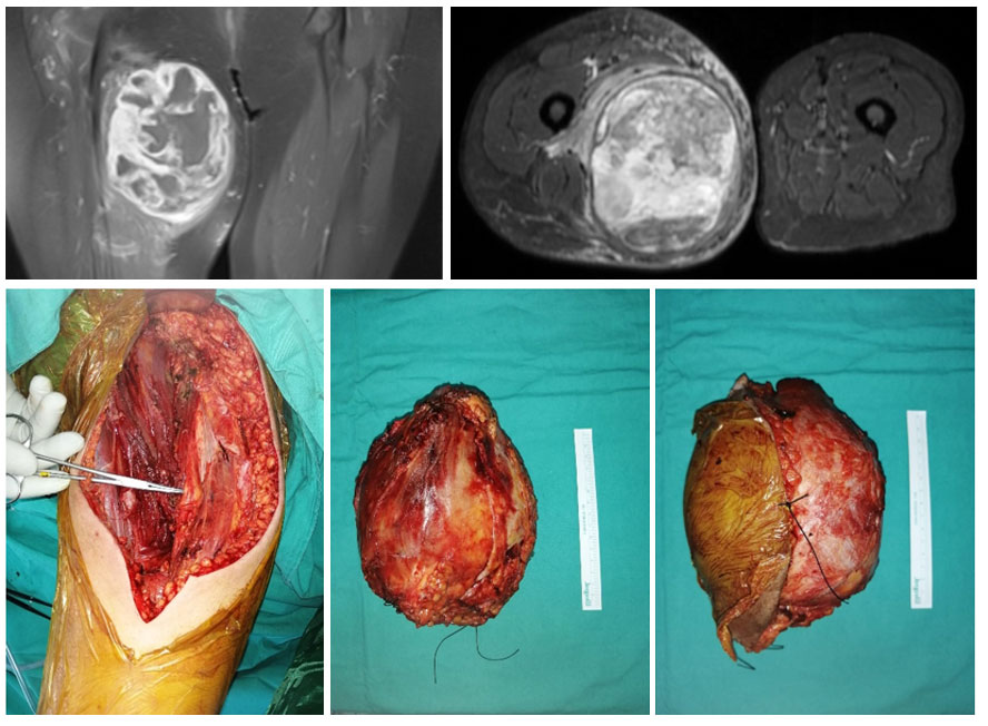 FIBROSARCOMA - MYXOFIBROSARCOMA