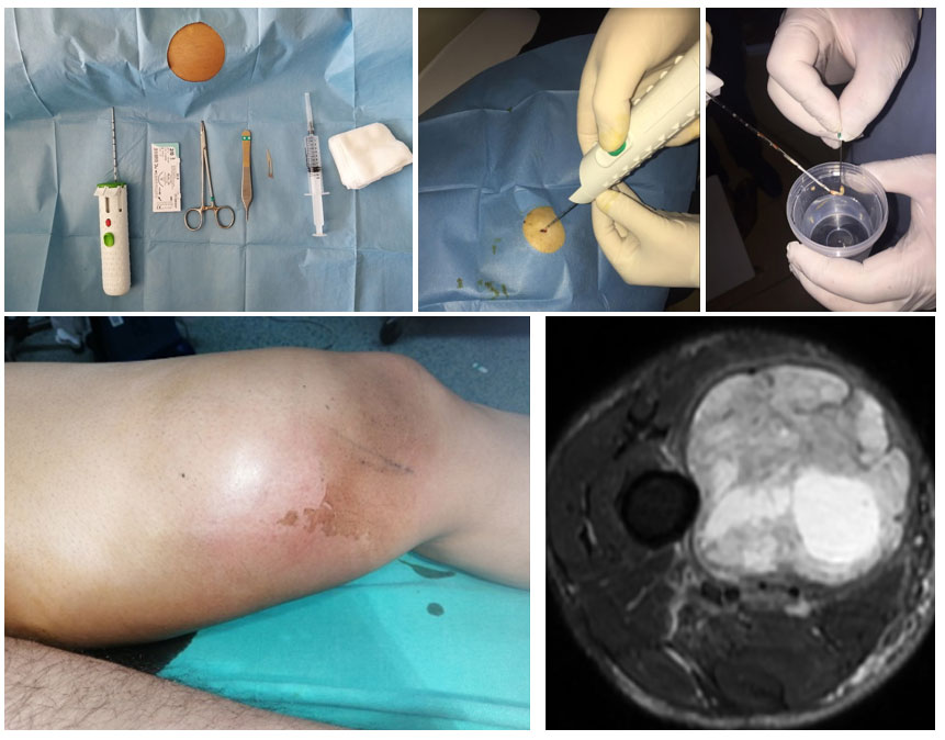 FIBROSARCOMA - MYXOFIBROSARCOMA