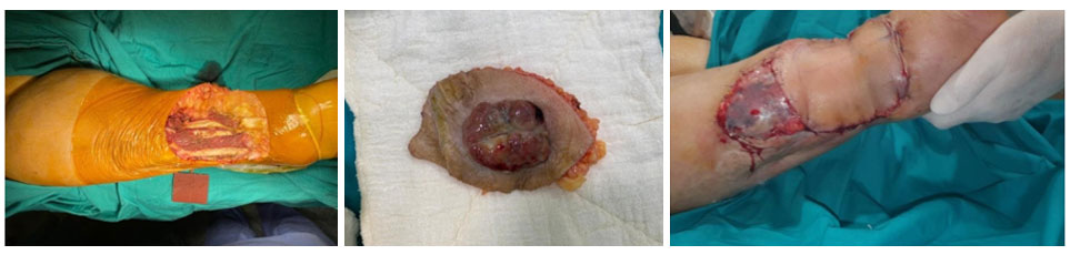 FIBROSARCOMA - MYXOFIBROSARCOMA