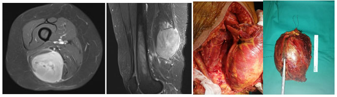 UNDIFFERENTIATED PLEOMORPHIC SARCOMA - MALIGNANT FIBROUS HISTIOCYTOMA