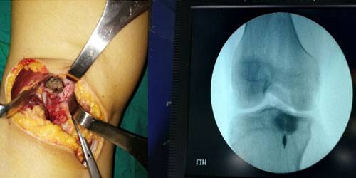 CHONDROBLASTOMA-CODMAN’S TUMOR