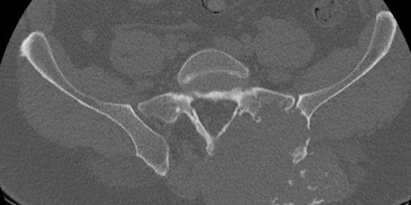 CHONDROSARCOMA