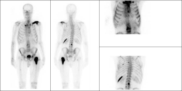 BONE METASTASIS