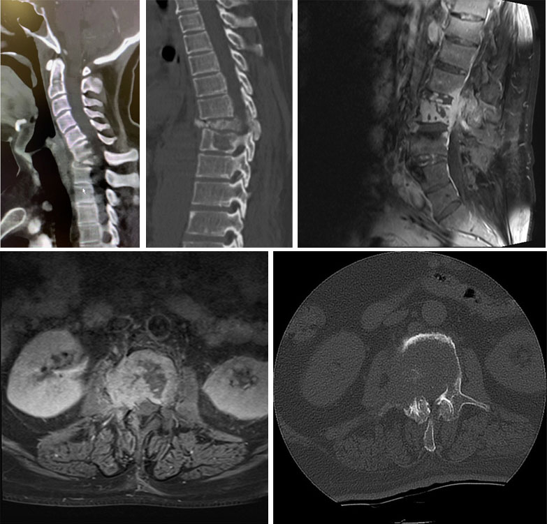 Spinal Metastasis (Cancer Spread to the Spinal Bones)