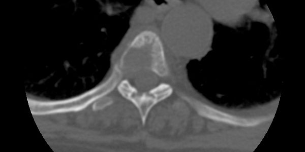 SPINE-VERTEBRAE TUMORS