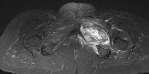 POST-RADIATION SARCOMA