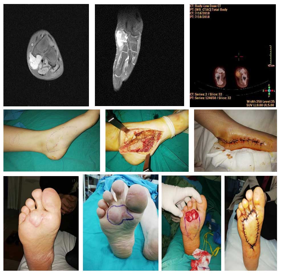 SYNOVIAL SARCOMA