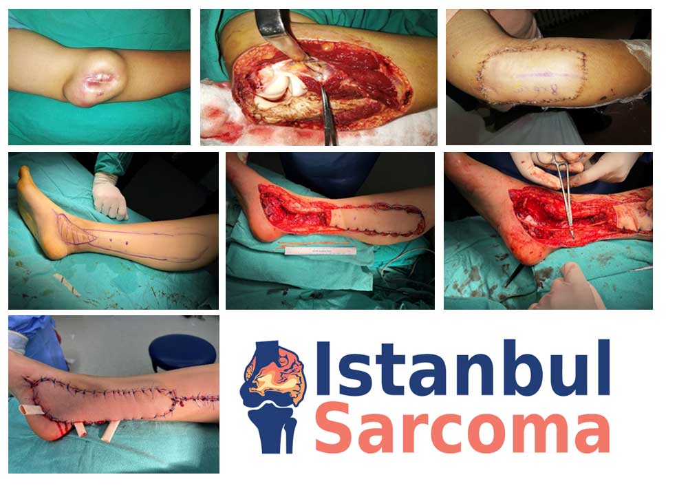 SYNOVIAL SARCOMA