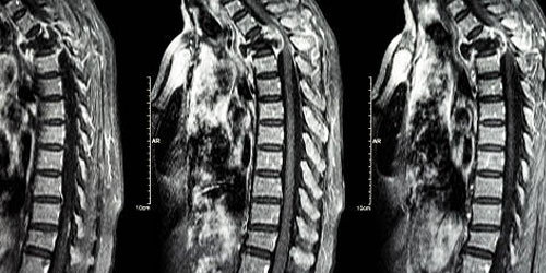 Omurga Metastazı (Kanserin Omurga Kemiklerine Sıçraması)
