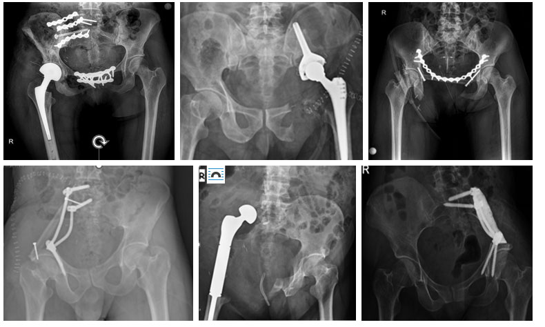 Pelvis - Asetabulum (Leğen Kemiği) Tümörleri ve Hemipelvektomi