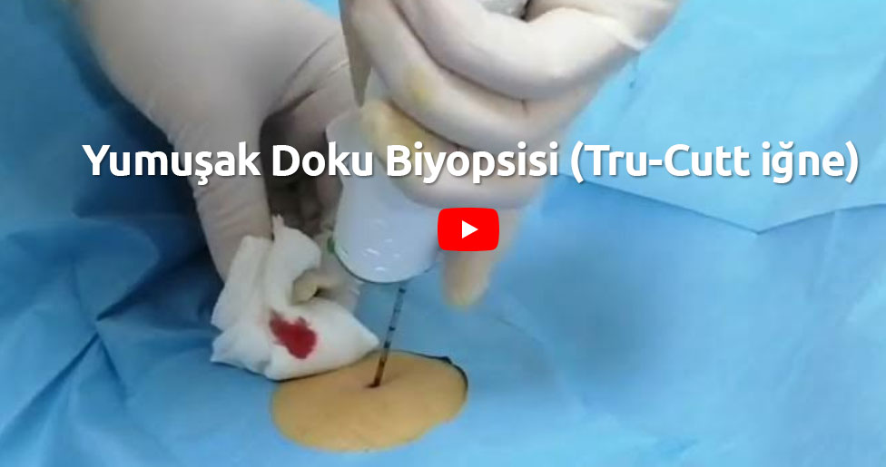 Video: Yumuşak Doku Biyopsisi (Tru-Cutt iğne)