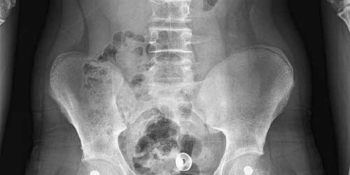 Vaka 28: Üçüncü Bel (L3) Omurgasında Anevrizmal Kemik Kisti