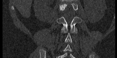 Vaka 29: Birinci Bel Omurgası (L1) Yerleşimli Osteoid Osteoma