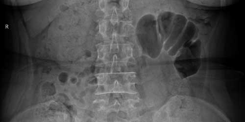 Vaka 30: İkinci Lomber Omurga Yerleşimli Dev Hücreli Kemik Tümörü