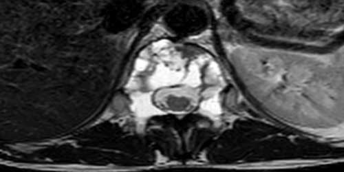 Vaka 31: Omurga (Vertebra) Yerleşimli Fibröz Displaziye Bağlı Çökme Kırıkları ve Kamburluk (Kifoz)