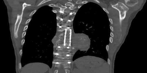 Vaka 32: Torokal Vertebra Nüks Osteosarkom