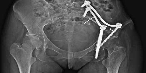 Vaka 33: Ewing Sarkom Lomber Omurga Metastazına Bağlı Patolojik Kırık Ve Omurilik/Sinir Kökü Basısı