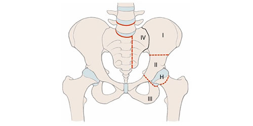 Pelvis - Asetabulum (Leğen Kemiği) Tümörleri ve Hemipelvektomi